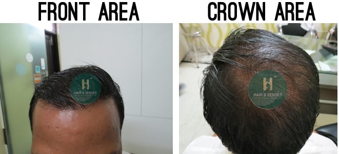 Hair Transplant Case Study